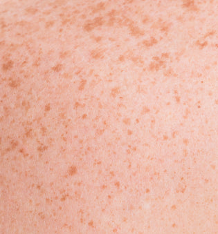 What Are Dark Spots?