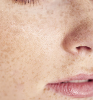  What Are Your Freckles Telling You?