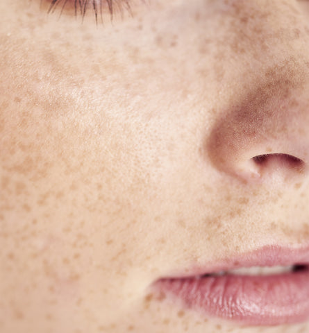 Blog Feed Article Feature Image Carousel: What Are Your Freckles Telling You? 