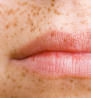  Do Freckles on Lips Spell Sun Damage