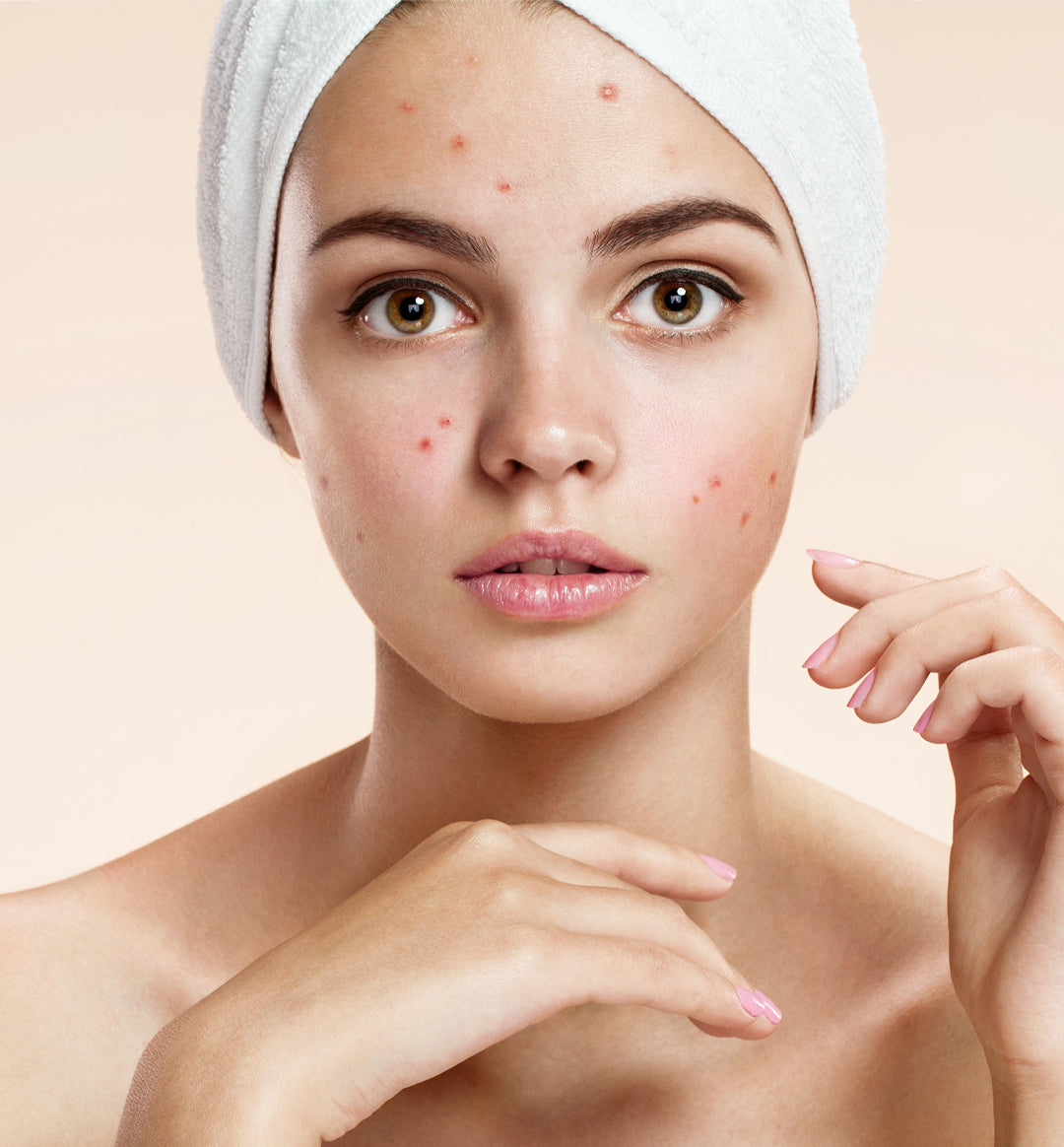Salicylic Acid vs. Salicin: Essential Acne Treatment Insights Salicylic Acid vs. Salicin: Essential Acne Treatment Insights
