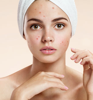  Acne Treatment Basics: Salicin Vs. Salicylic Acid