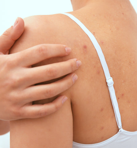 Blog Feed Article Feature Image Carousel: The Best Natural Body Acne Treatments 