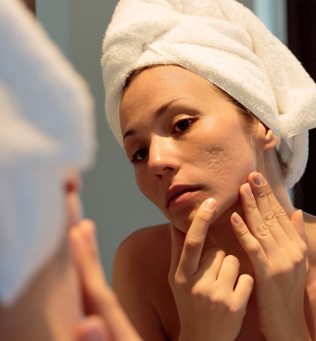 Blog Feed Article Feature Image Carousel: How to Fade Acne Scars 