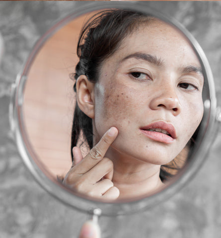 Blog Feed Article Feature Image Carousel: Tips for Managing Melasma 