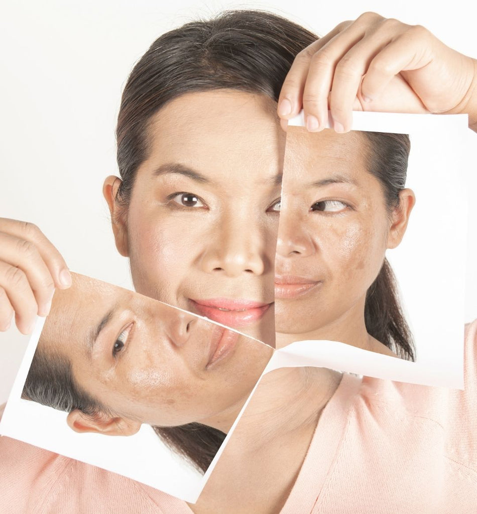 Flawless Skin: Transform Dark Spots with 100% PURE