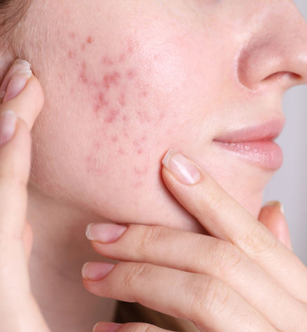 Blog Feed Article Feature Image Carousel: Acne Scars Be Gone: 7 Natural Solutions for Flawless Skin 