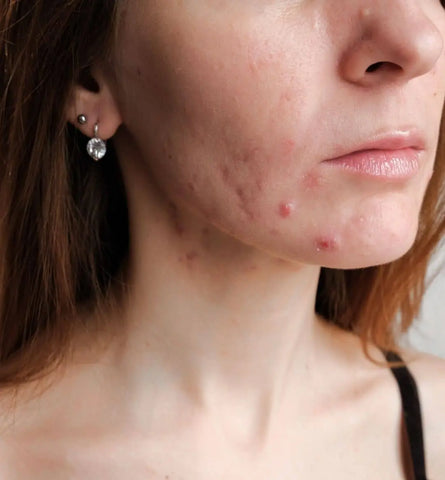 Blog Feed Article Feature Image Carousel: Hormonal vs. Bacterial Acne: Here's How to Tell Which Type You Have 