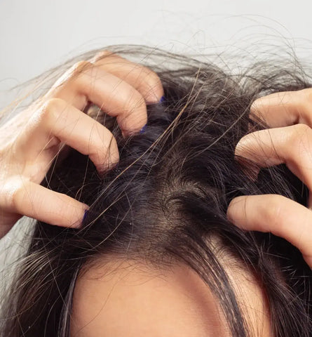 Blog Feed Article Feature Image Carousel: Itchy Scalp Driving You Crazy? Try These 5 Natural Remedies ASAP! 