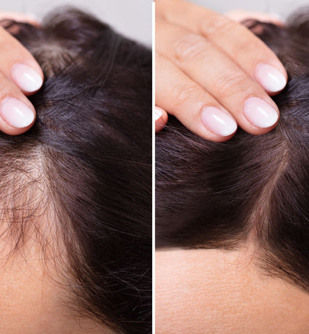 Blog Feed Article Feature Image Carousel: Natural Solutions for Hair Loss: Your Complete Guide to Regrowth 