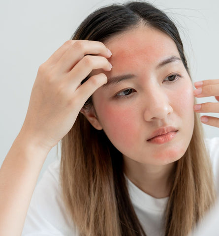 Blog Feed Article Feature Image Carousel: Understanding and Treating Rosacea Flare-Ups in Colder  Months 