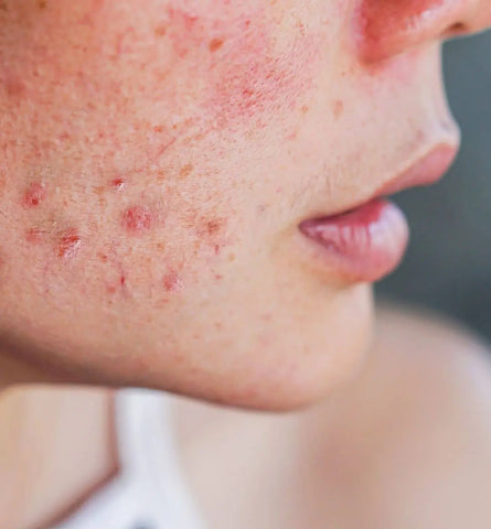 Blog Feed Article Feature Image Carousel: Summer Acne SOS – Banish Breakouts 