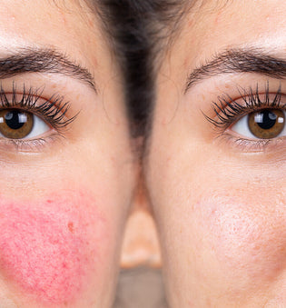  5 Signs Your Blotchy Skin Might Be Allergies