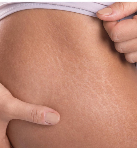 Blog Feed Article Feature Image Carousel: Vitamin E for Scars and Stretch Marks 