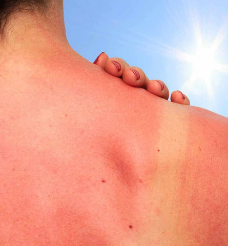Blog Feed Article Feature Image Carousel: The Best Way to Treat Sunburn Naturally 