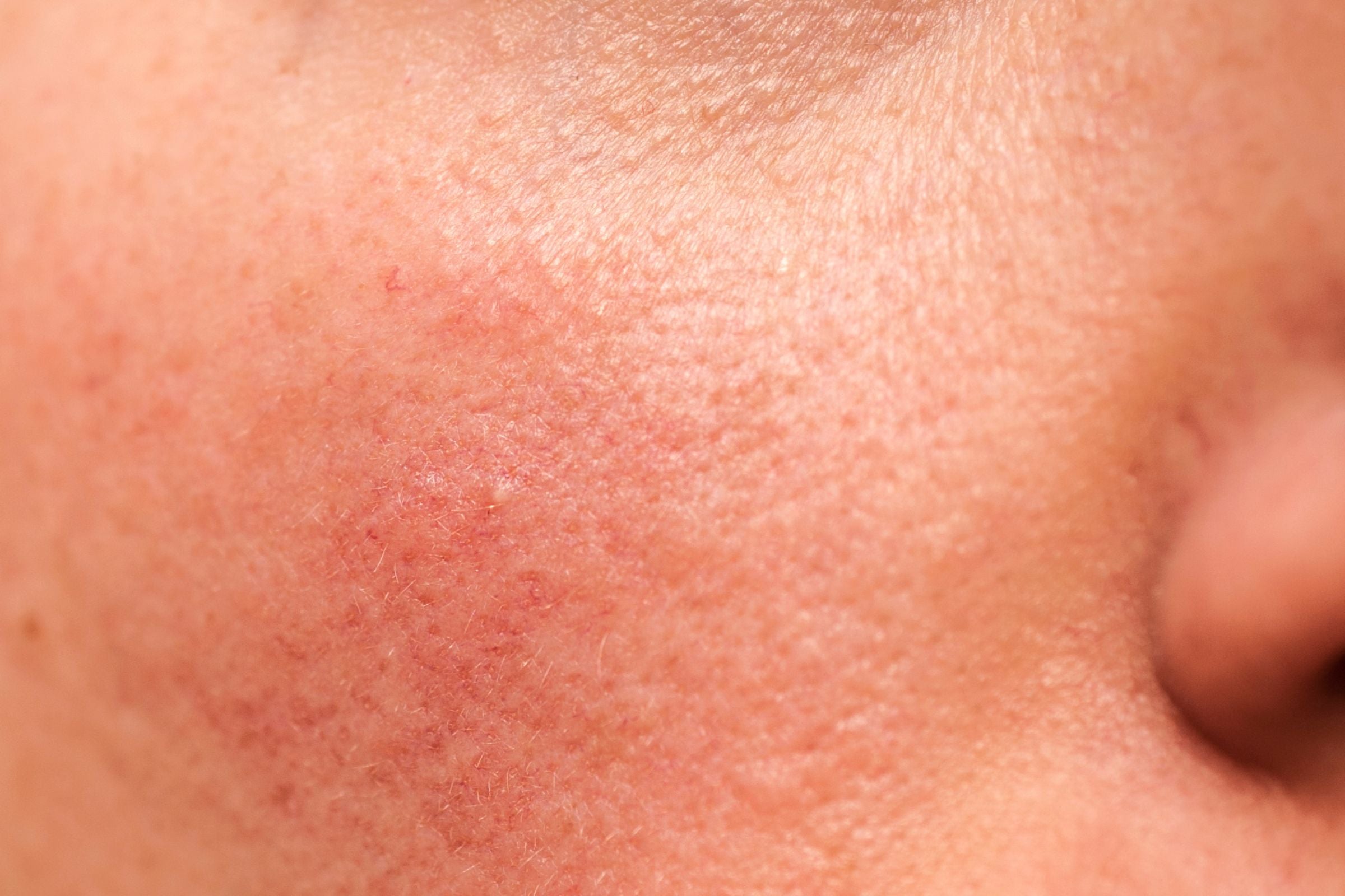5 Tips To Improve Your Uneven Skin Texture – 100% PURE