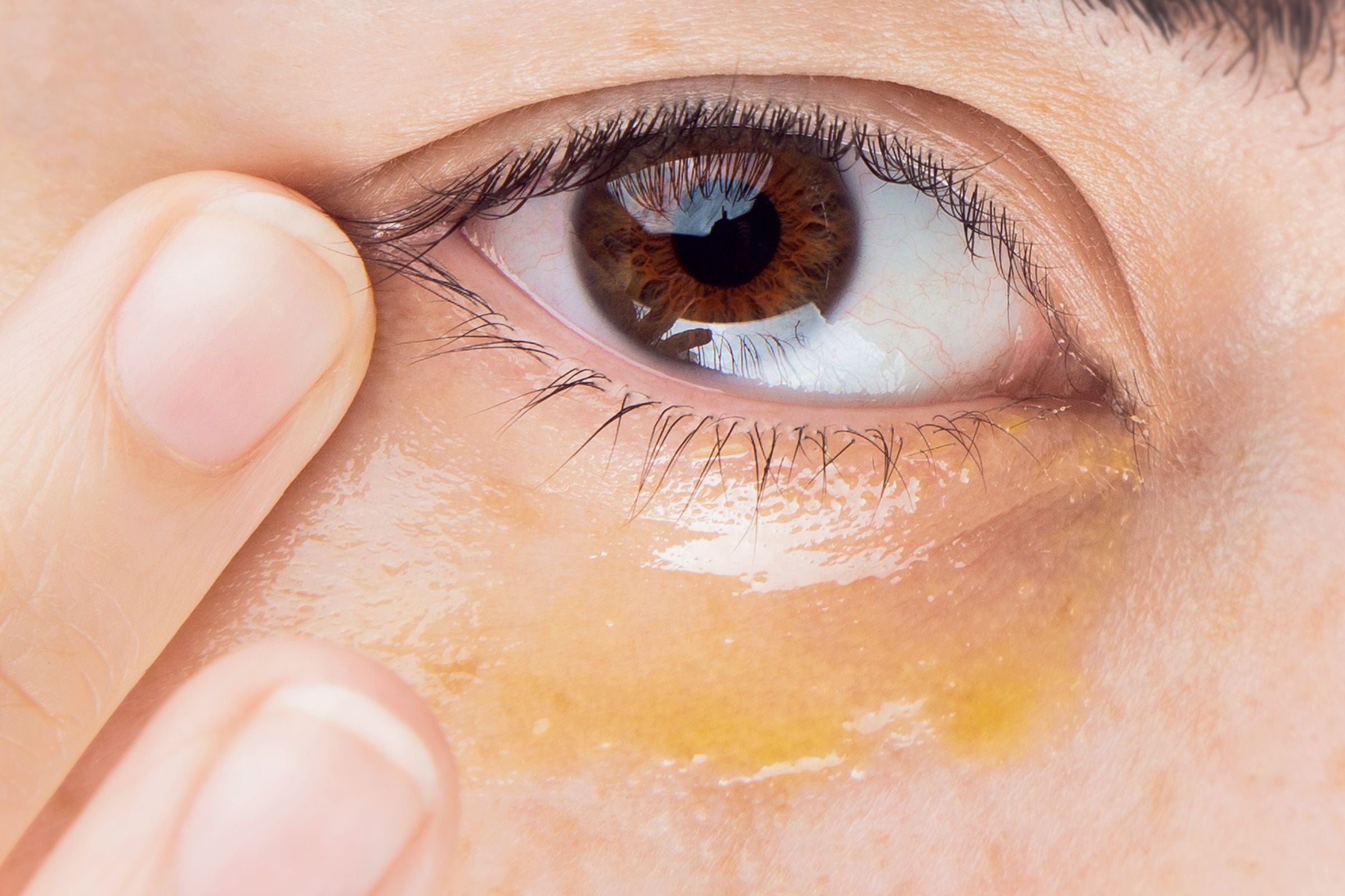Cover_Photo_-_100__Pure_How_To_Quickly_Treat_Dry_Under_Eyes