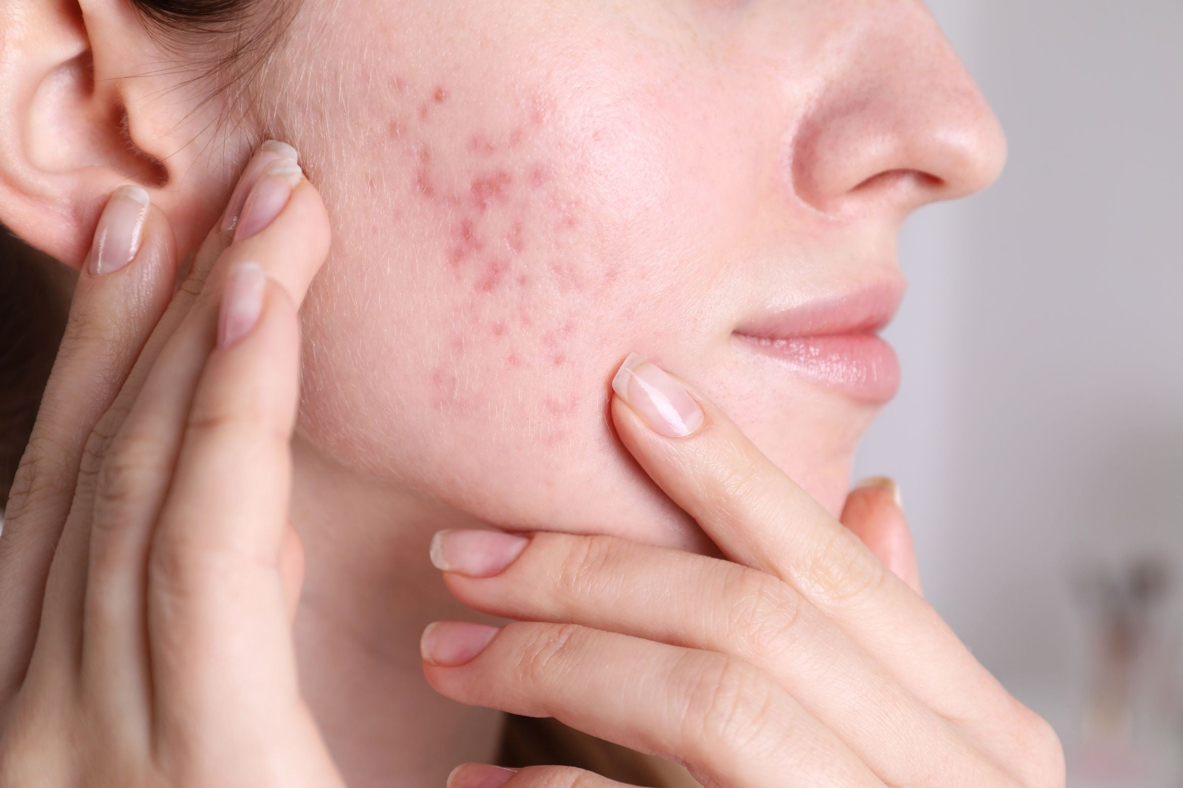 Cover_Photo_100_PURE_Acne_Scars_Be_Gone__7_Natural_Solutions_for_Flawless_Skin