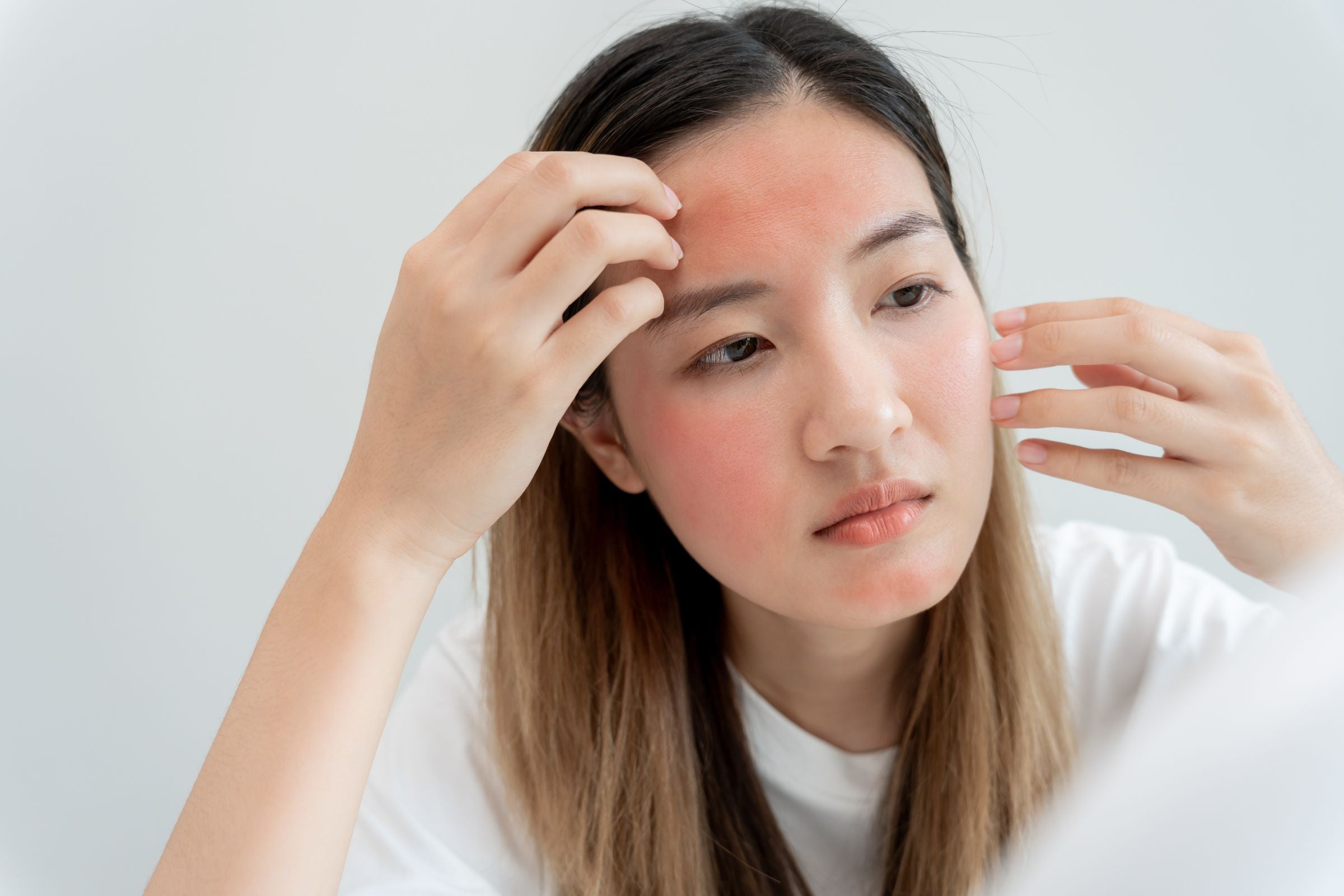 Cover_Photo_100_PURE_Understanding_and_Treating_Rosacea_Flare-Ups_in_Colder_Months