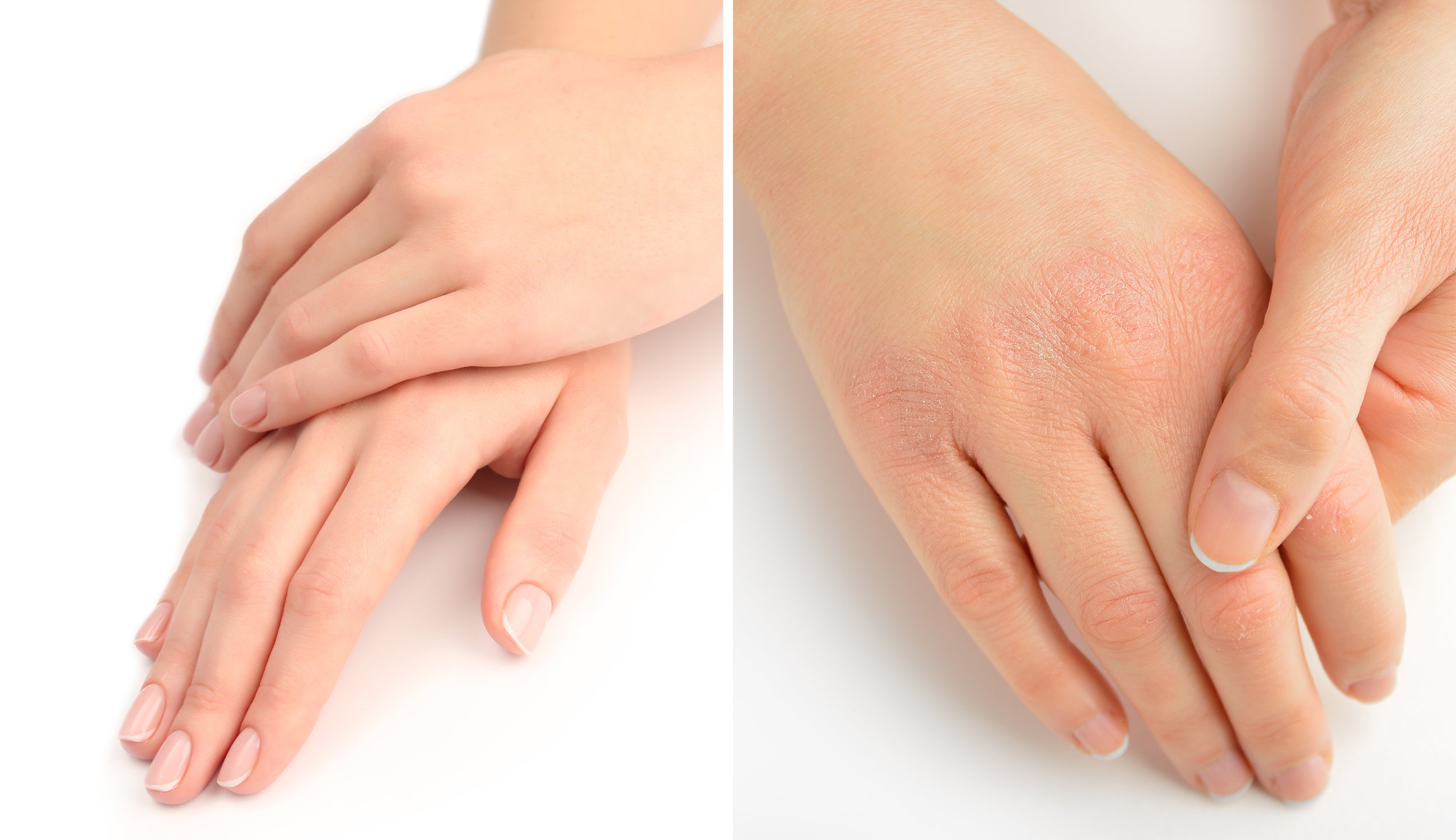 Dry-Skin-Versus-Moist-Hands