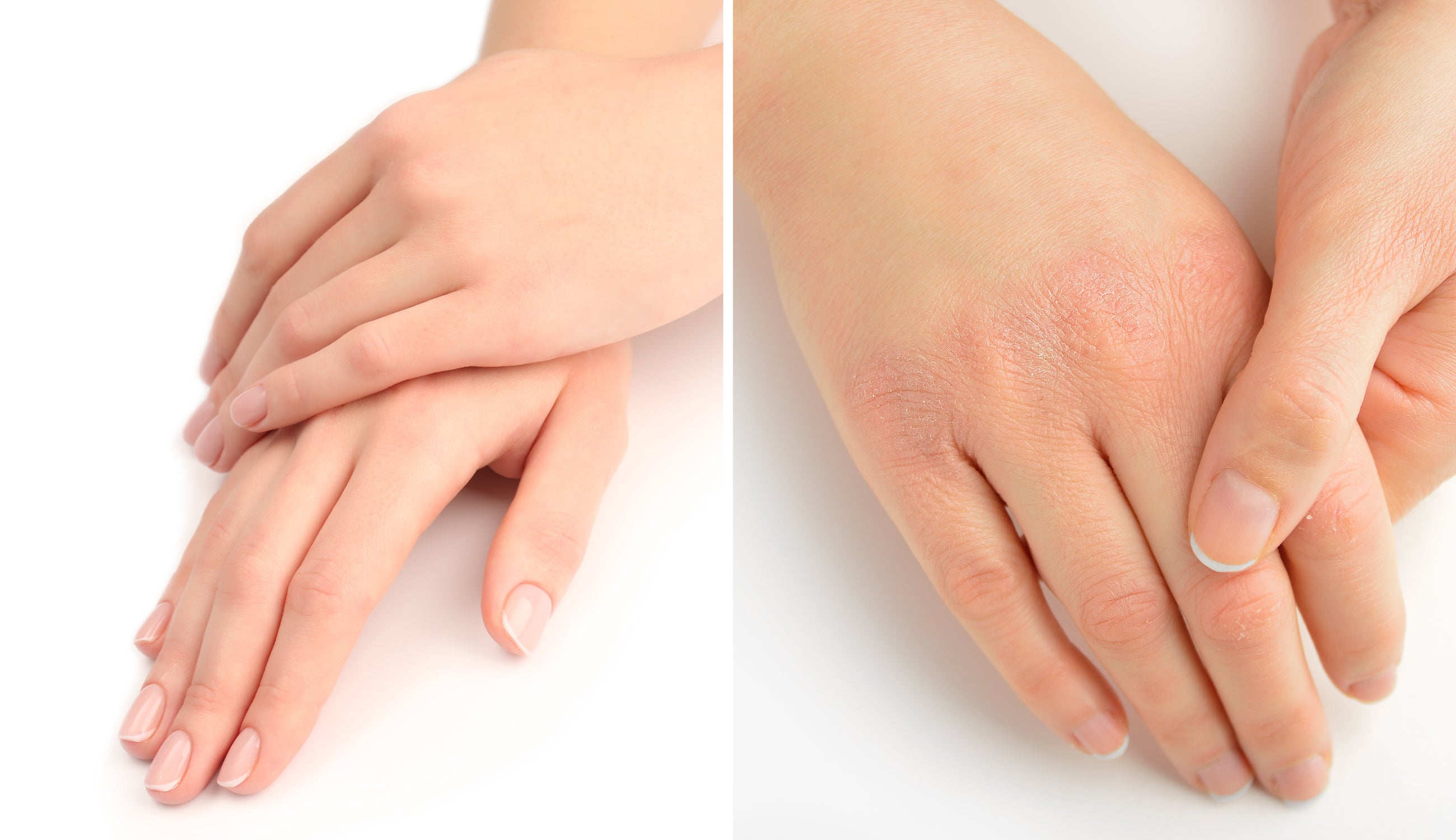 Dry-Skin-Versus-Moist-Hands
