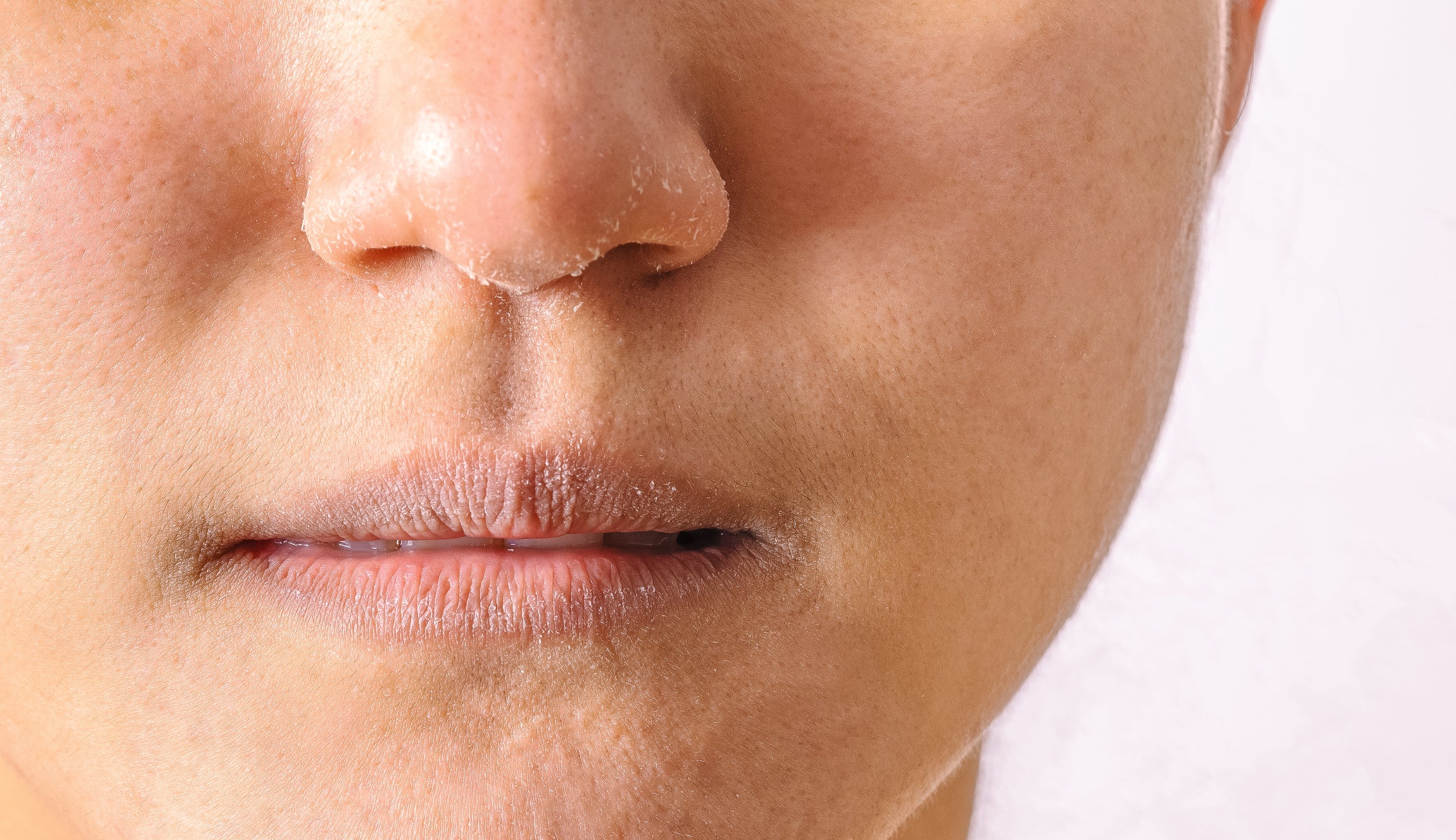 Woman with dry and peeling skin and lips