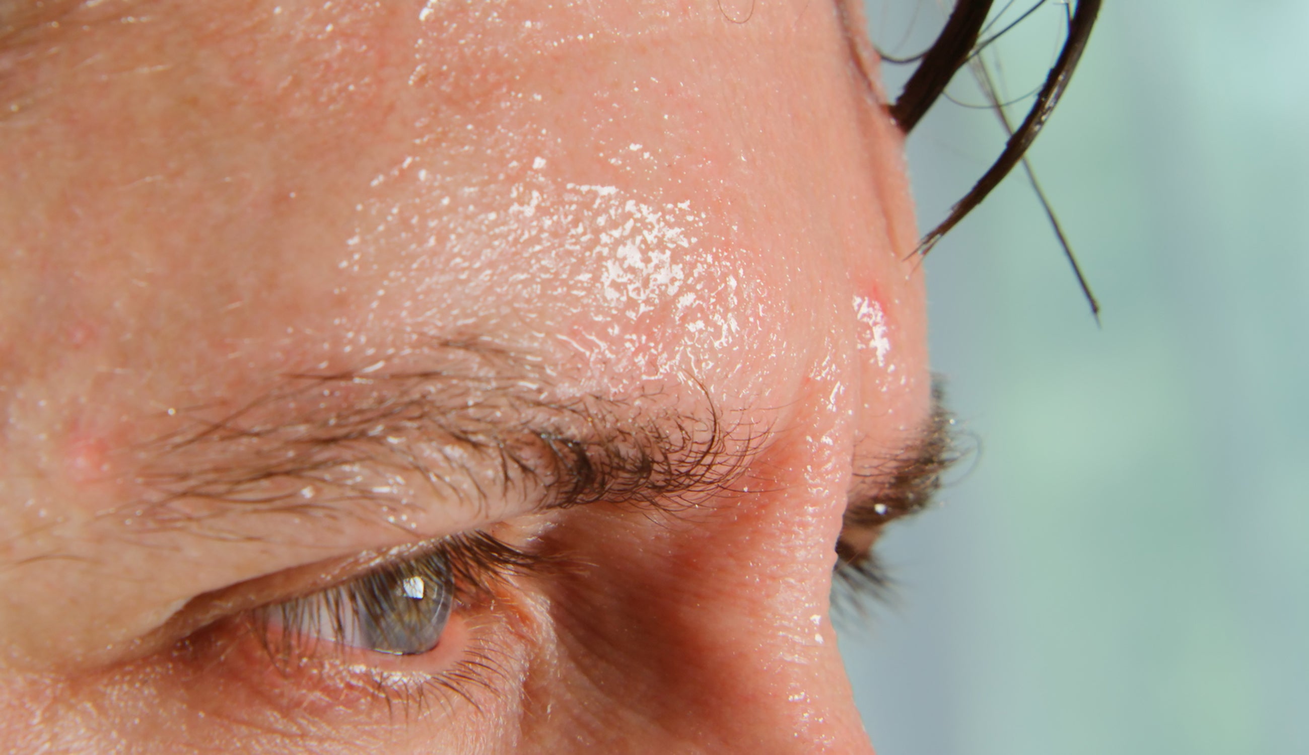 Forehead-Sweat