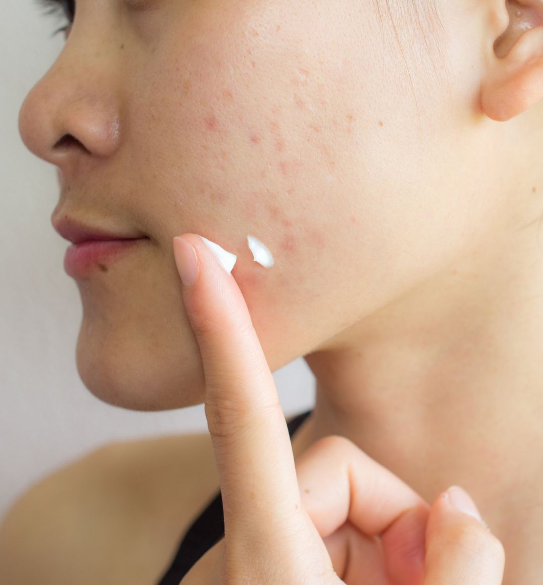 Girl_with_Acne