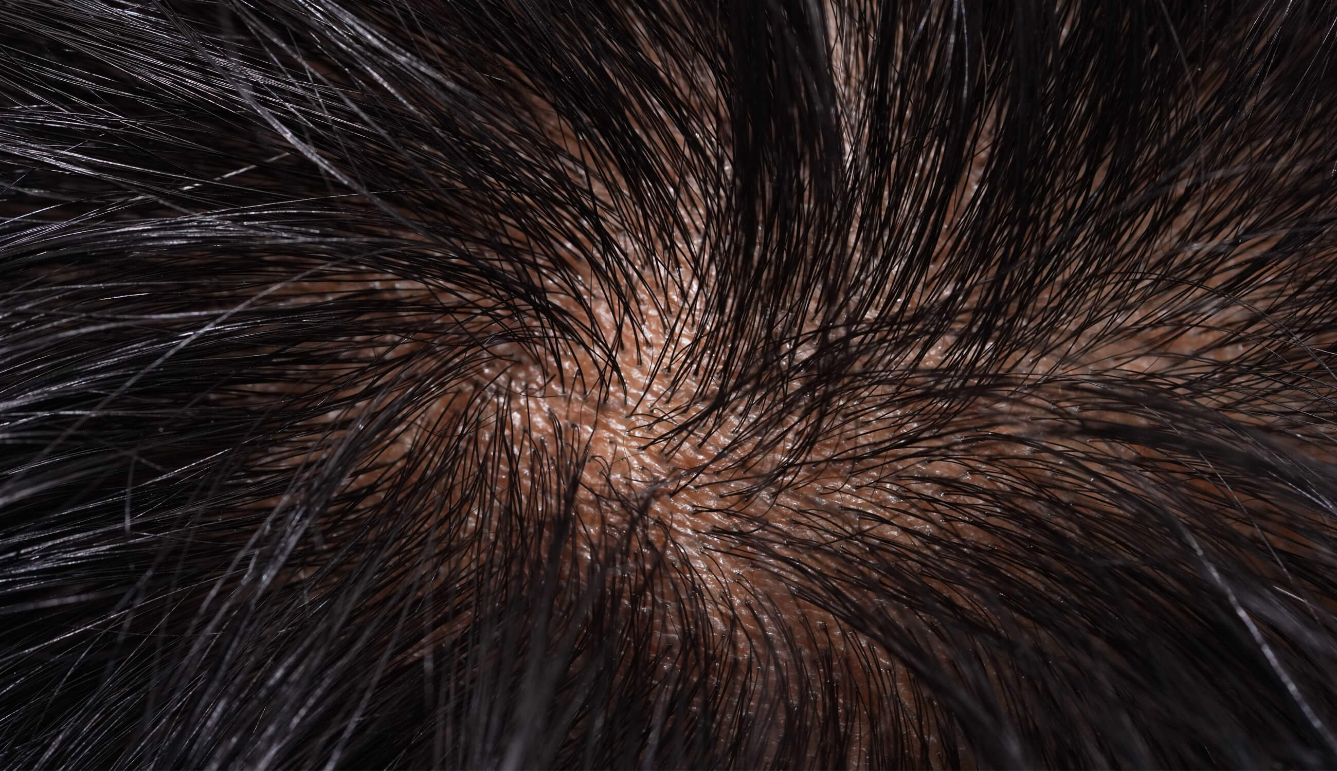 Hair scalp