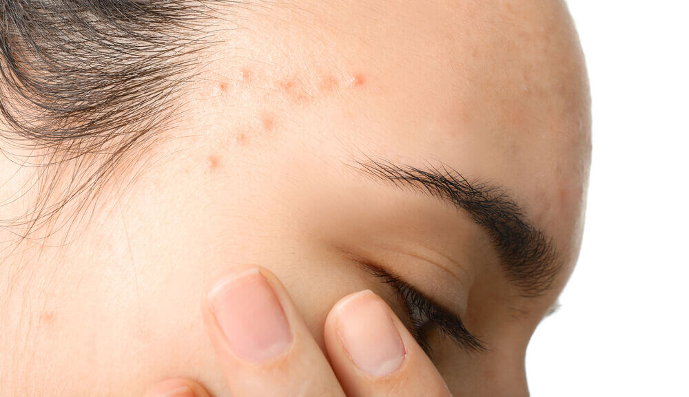 acne-prone skin.jpg
