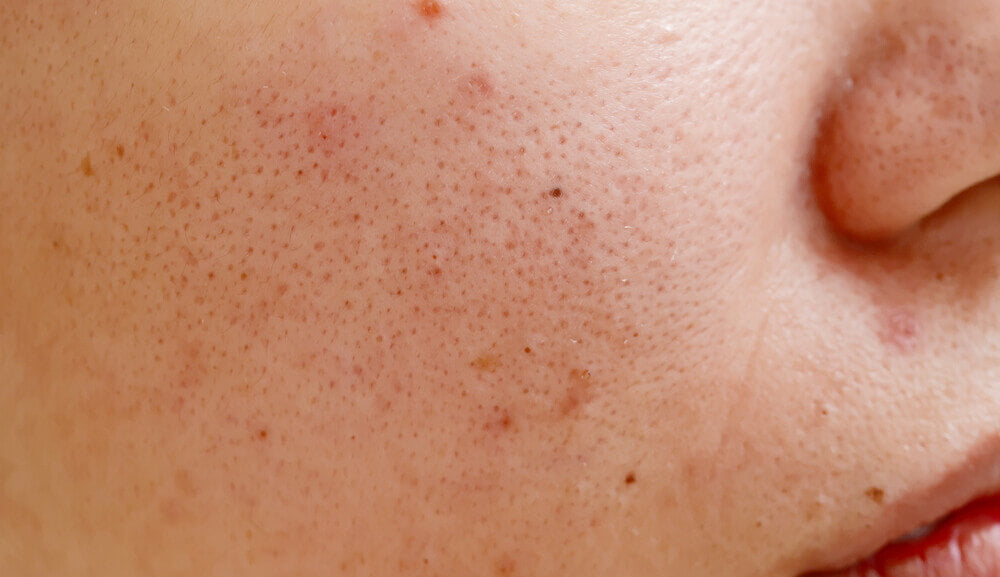 acne-prone-skin.jpg
