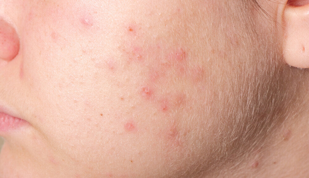 Acne texture.jpg