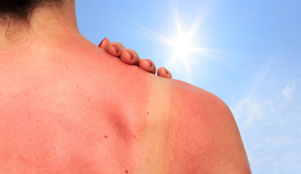 Main_sunburn on skin.jpg