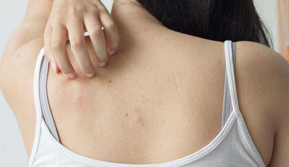 Main_woman with back acne.jpg