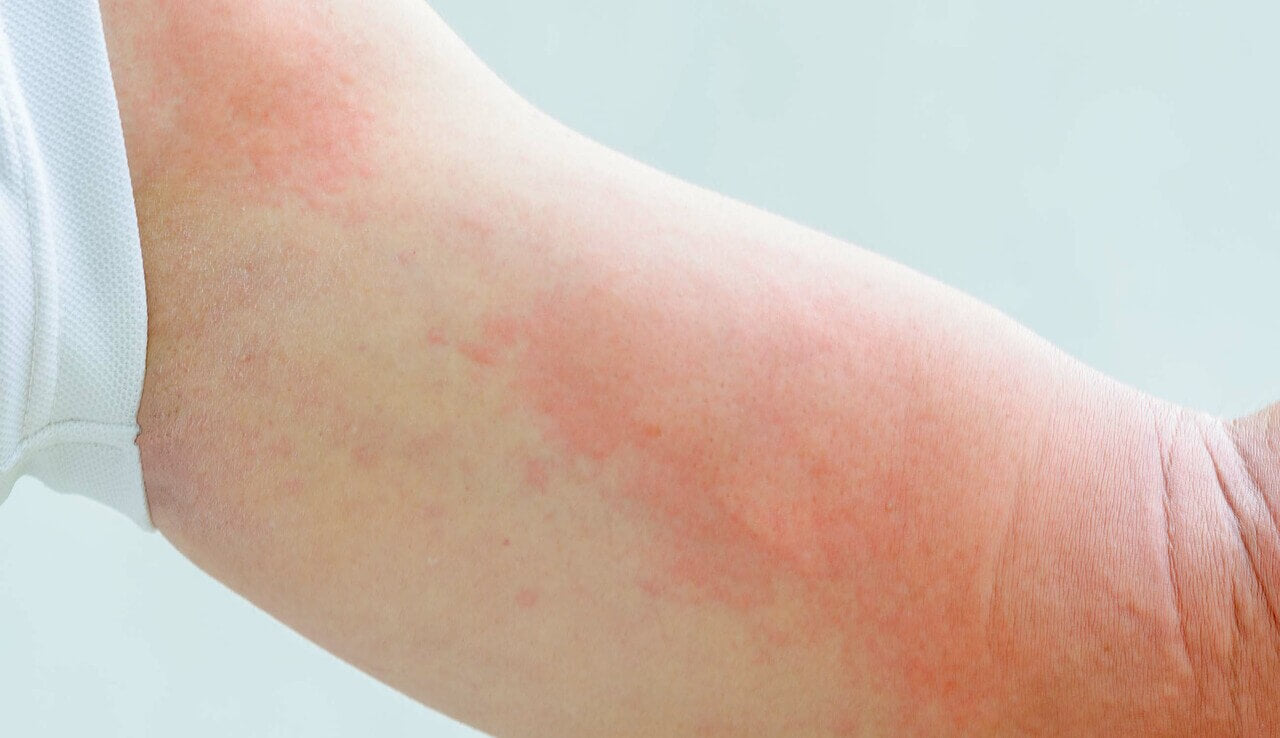 skin rash.jpg