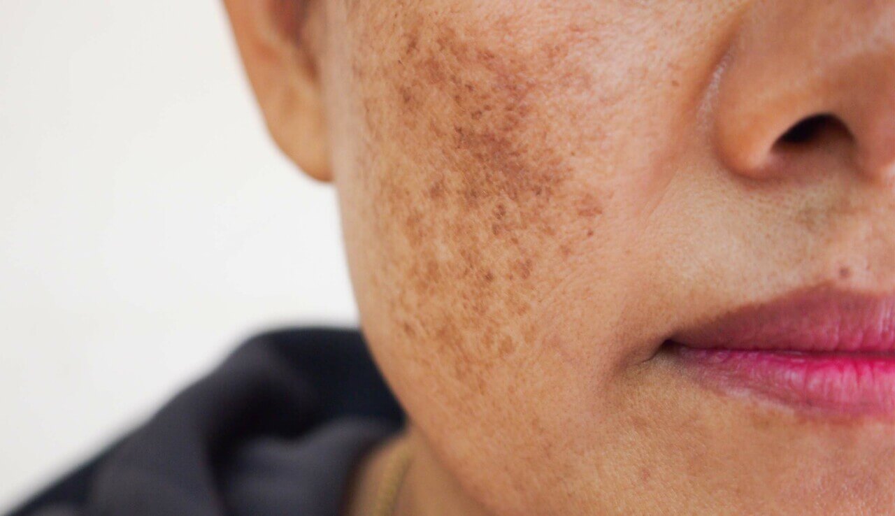 Skin with dark spots.jpg