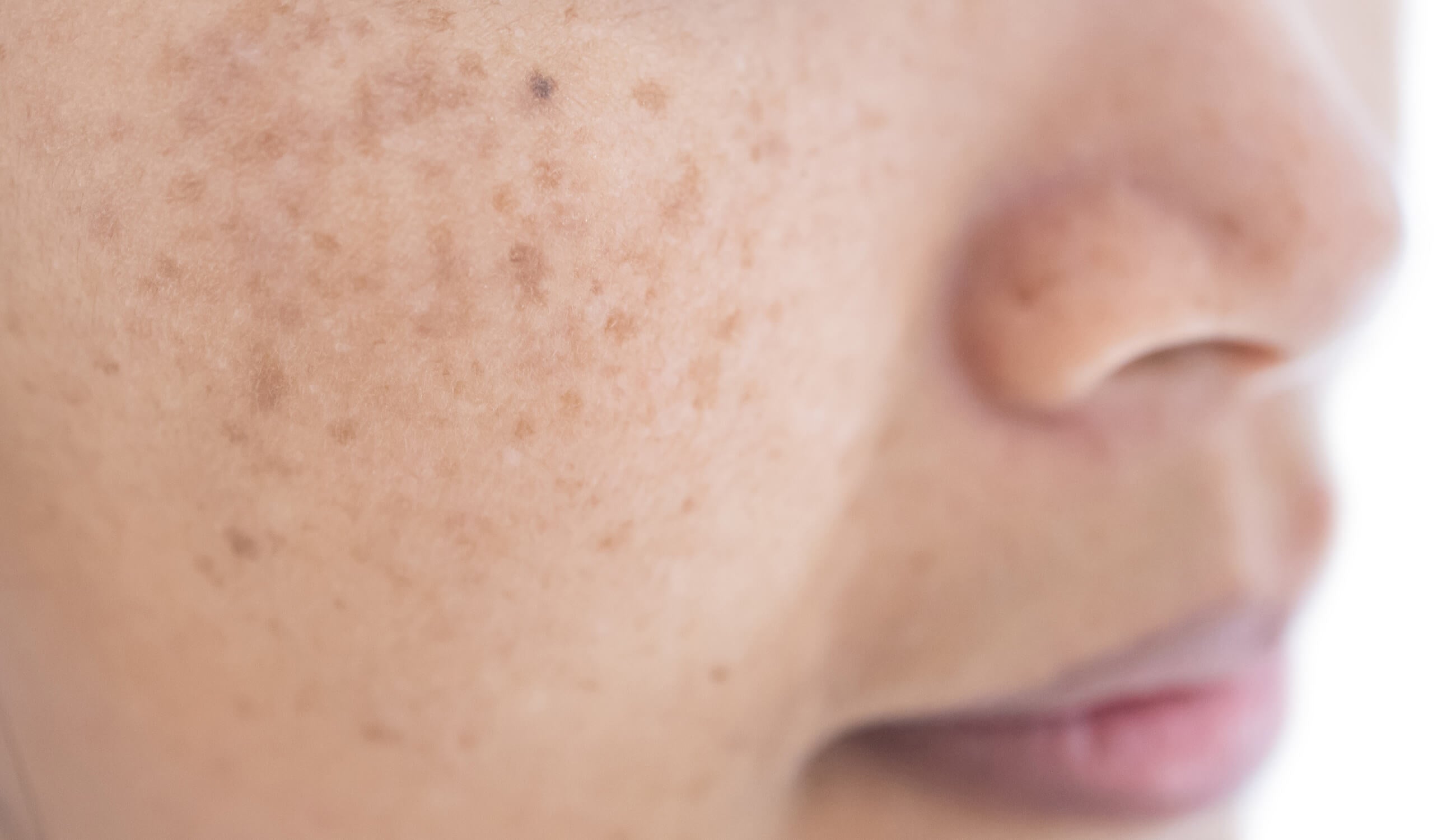 melasma.jpg