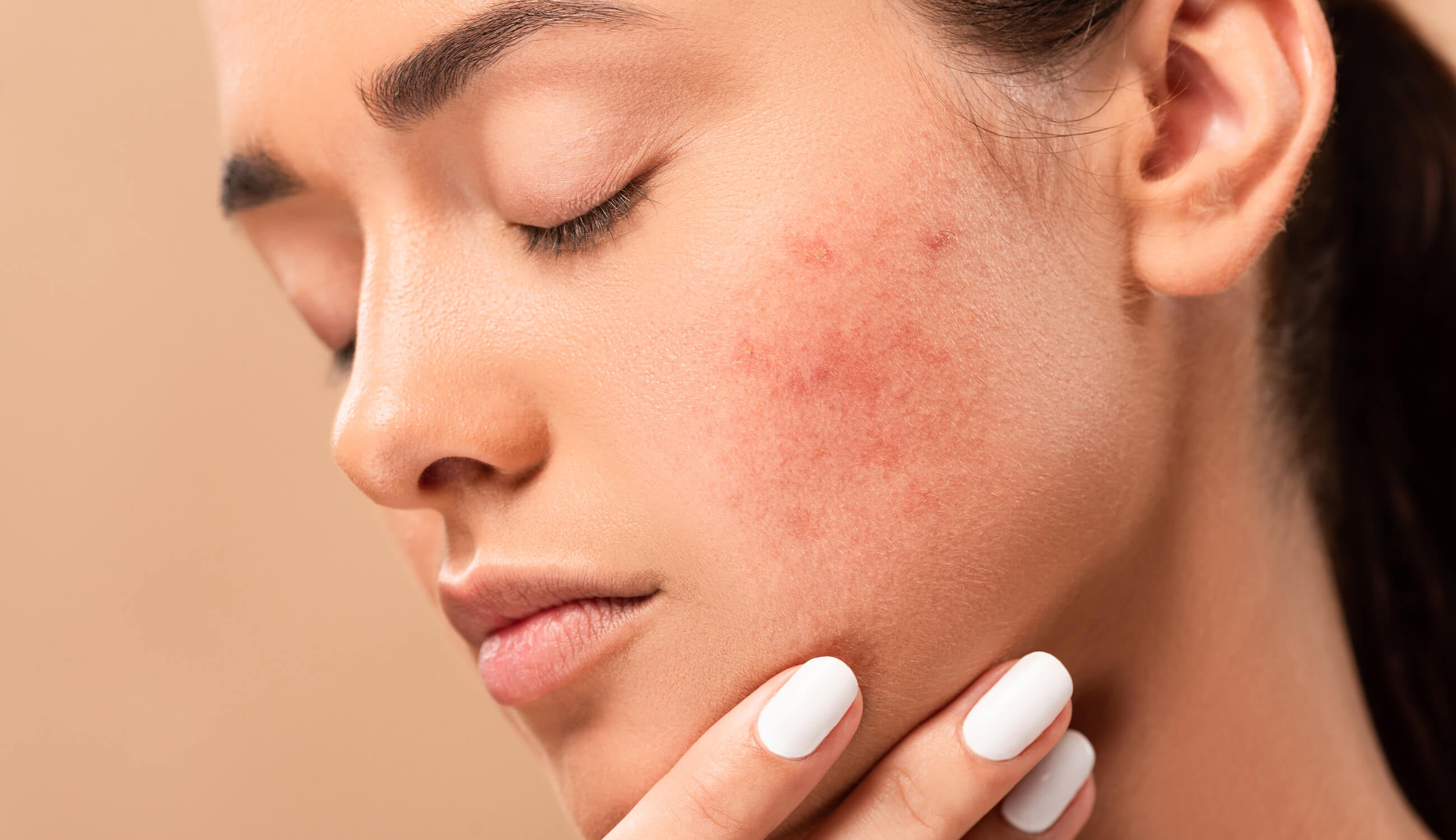 Woman’s skin with redness