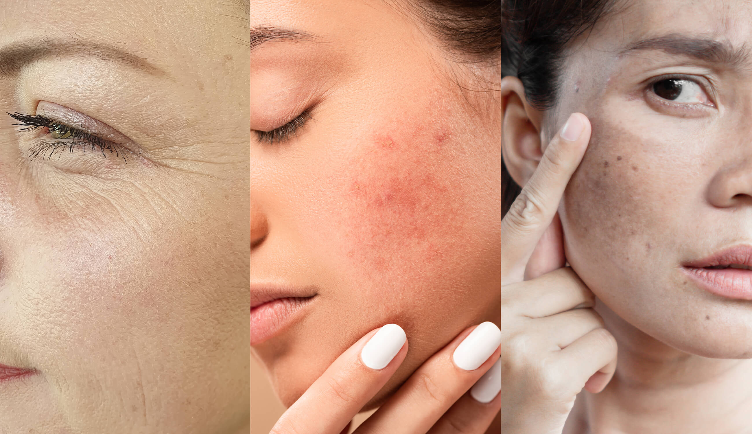 Wrinkles, acne spots, melasma